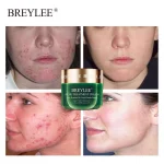 BREYLEE Acne Treatment Cream