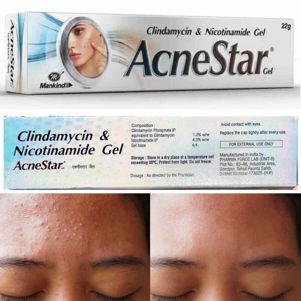 AcneStar Gel