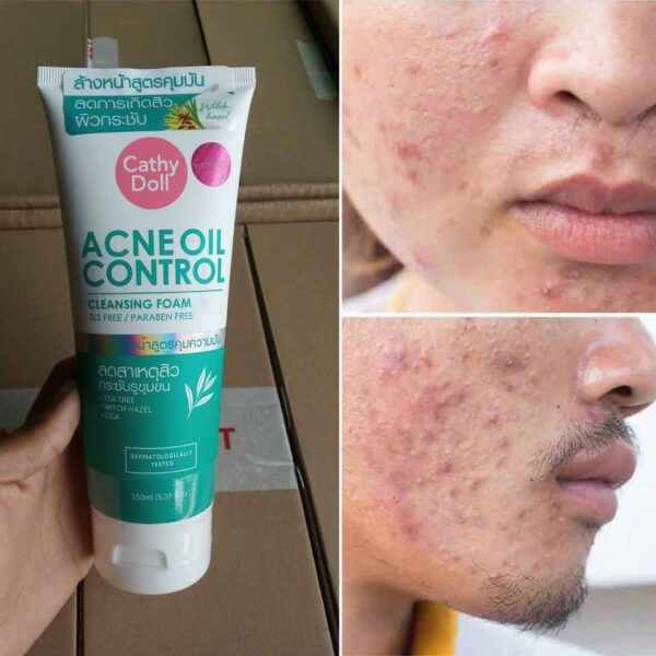 Acne Oil Control Face Wash